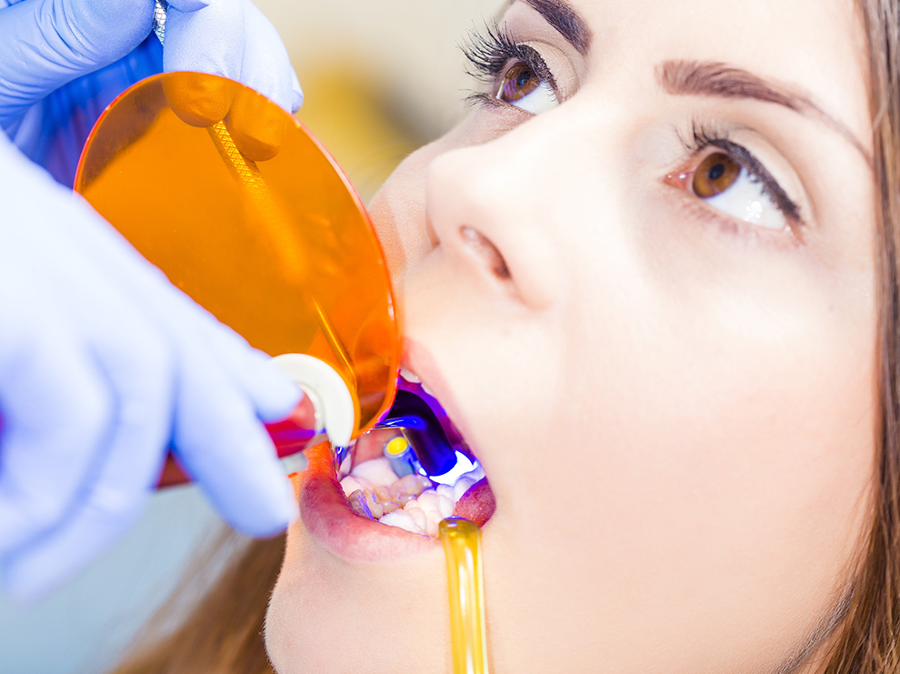 Composite tooth bonding