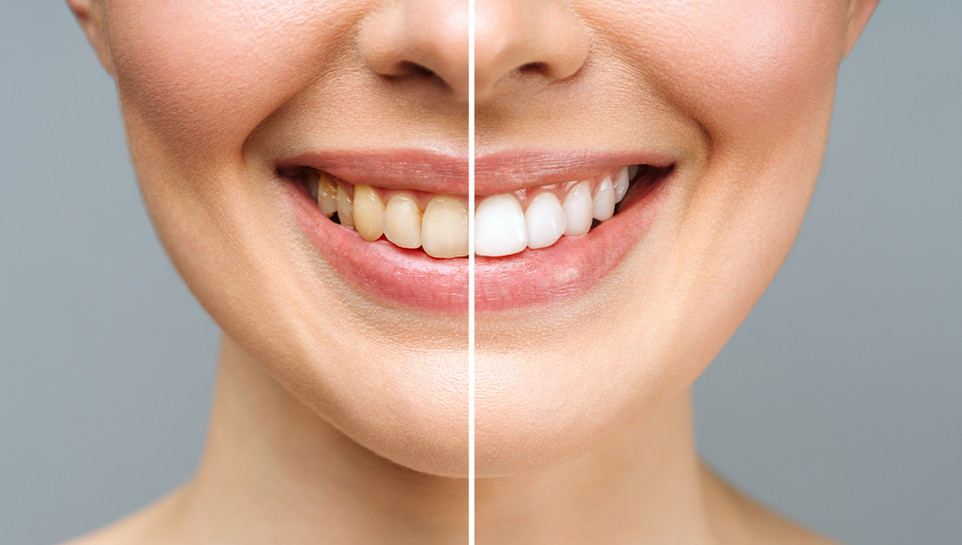 Before and after of visit to Wisdom dental in Leigh on Sea