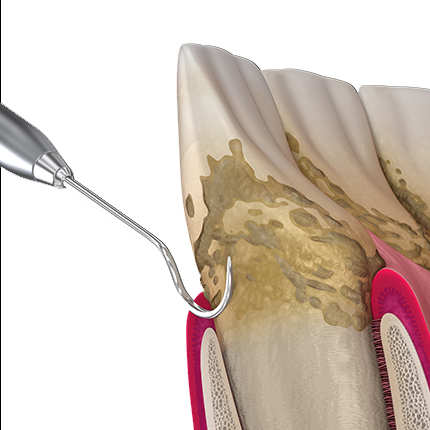 Diagram of periodontal dental hygienist probe cleaning a tooth