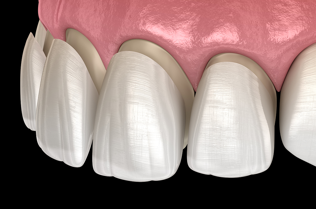 Porcelain dental veneers