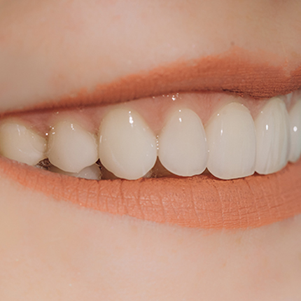 Composite bonding for client in Leigh on Sea