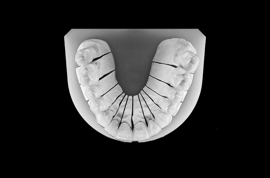 Smile makeover